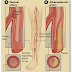 Cook Medical Showcases Advancements for Treating Vascular Disease at ISET 2010 With Clinical Trial Updates